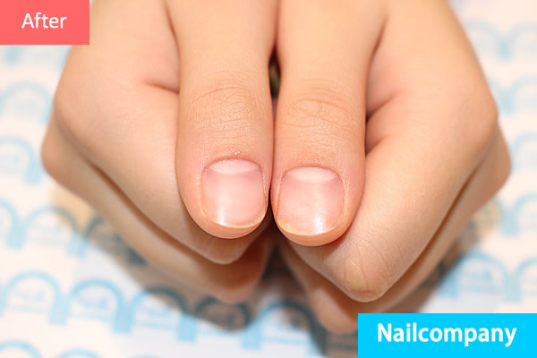 睡眠中に舌を噛む症状