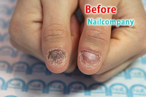 爪噛みをやめる戦略