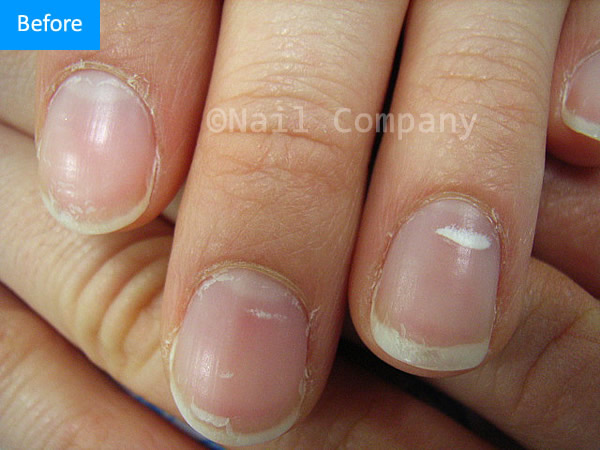 爪に白い斑点ができる他の原因は何ですか?